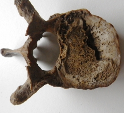 Leprosy skeleton spinal compression fracture